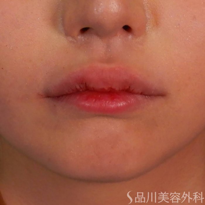 症例NO.66934のAFTER写真