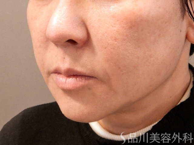 症例NO.69756のBEFORE写真