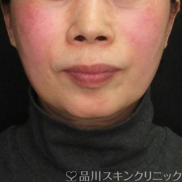 症例NO.69777のBEFORE写真