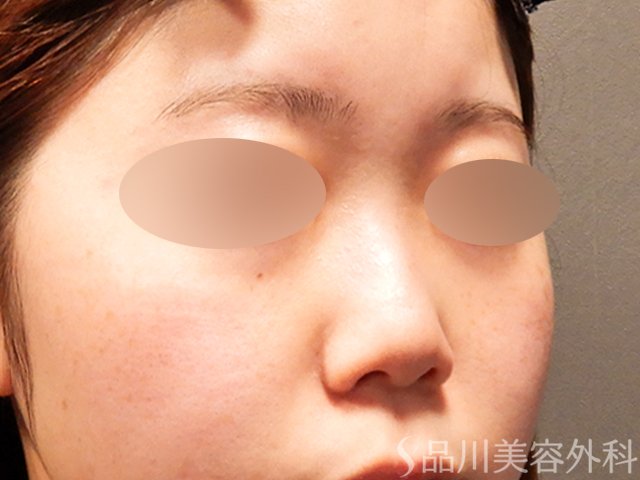 症例NO.69518のBEFORE写真