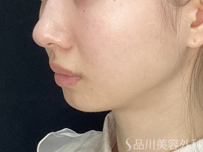 症例NO.71630のBEFORE写真