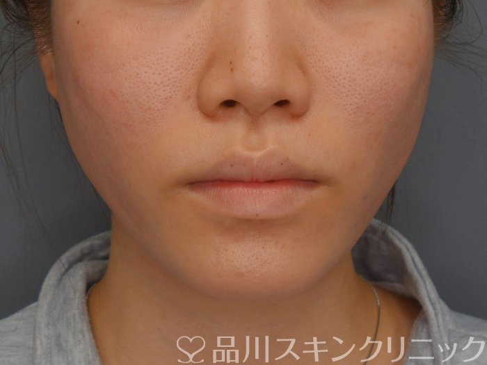 症例NO.74011のAFTER写真