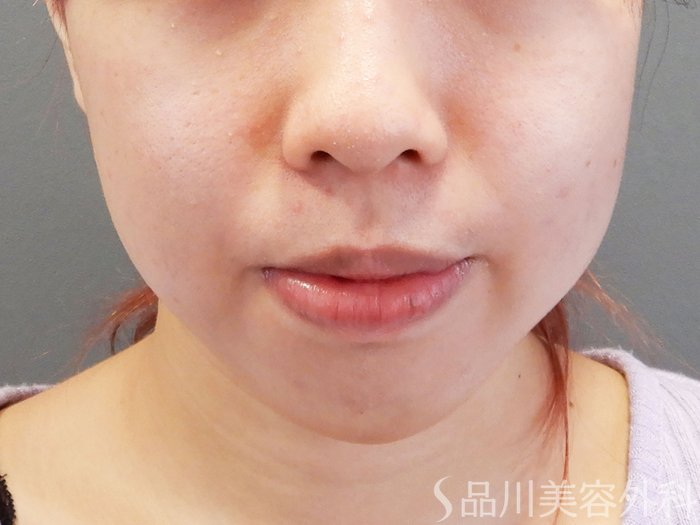 症例NO.70194のBEFORE写真