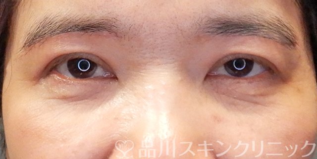 症例NO.67490のAFTER写真
