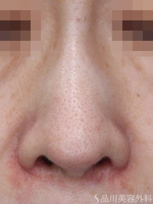 症例NO.69597のAFTER写真