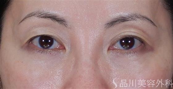 症例NO.60039のAFTER写真