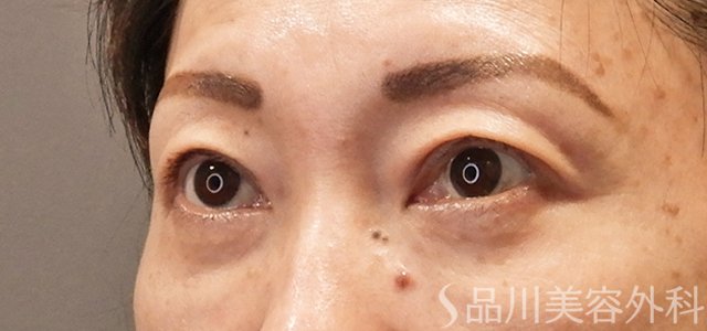 症例NO.73131のAFTER写真