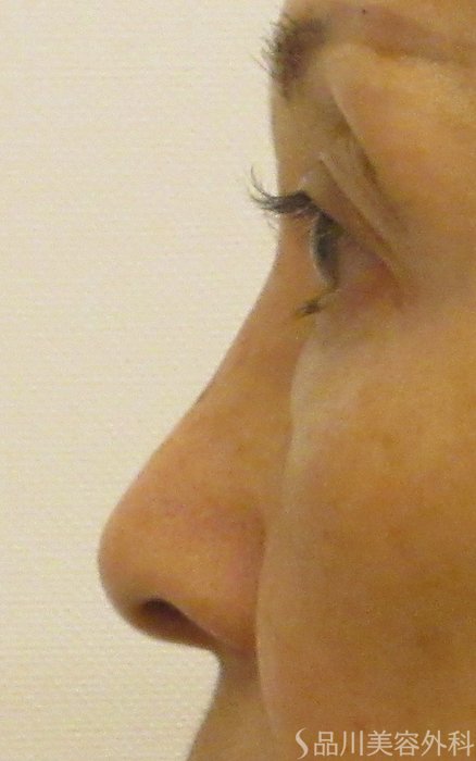 症例NO.70710のBEFORE写真