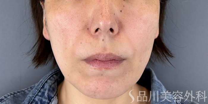 症例NO.70177のBEFORE写真