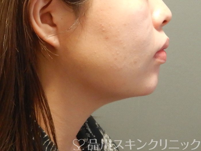 症例NO.62168のAFTER写真