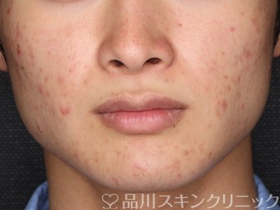 症例NO.74178のBEFORE写真