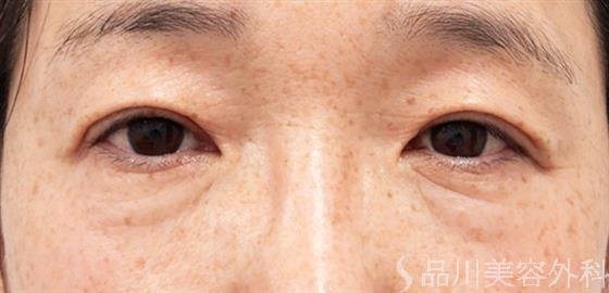 症例NO.52411のAFTER写真