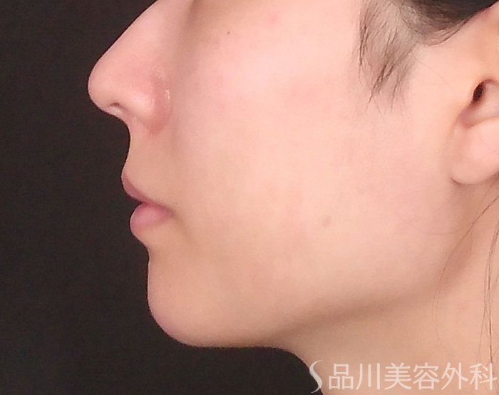 症例NO.71813のBEFORE写真
