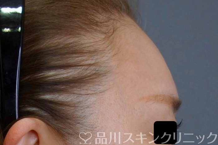 症例NO.74587のAFTER写真