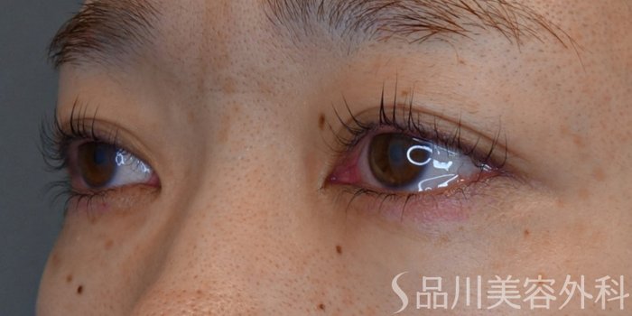 症例NO.73329のBEFORE写真