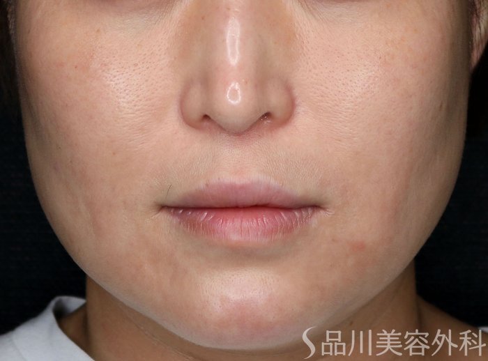 症例NO.73451のAFTER写真