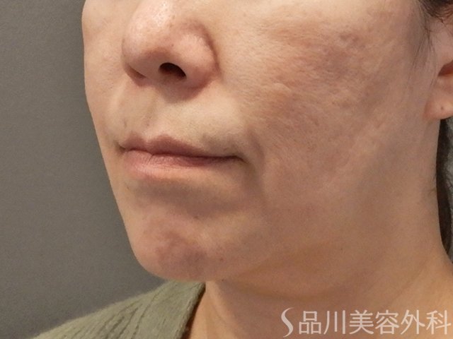 症例NO.73268のBEFORE写真