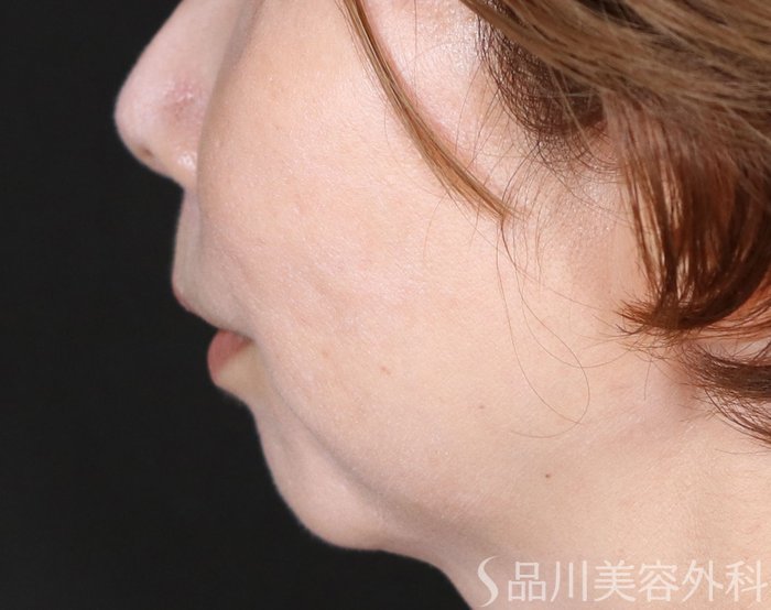 症例NO.71863のBEFORE写真