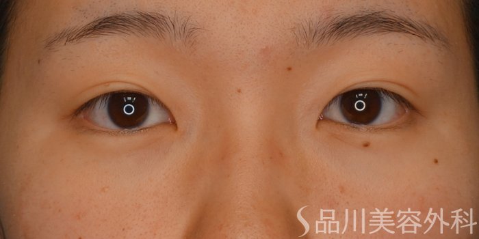 症例NO.73236のBEFORE写真