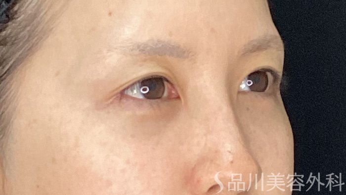 症例NO.71147のAFTER写真
