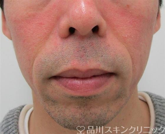 症例NO.33447のBEFORE写真