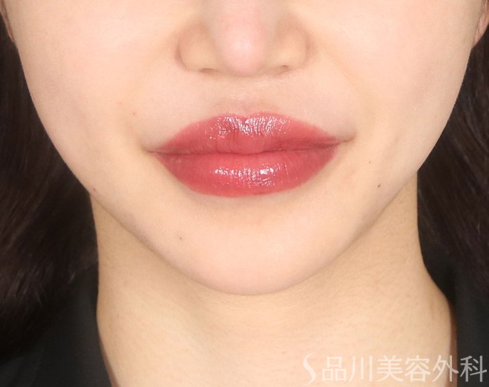 症例NO.73534のAFTER写真