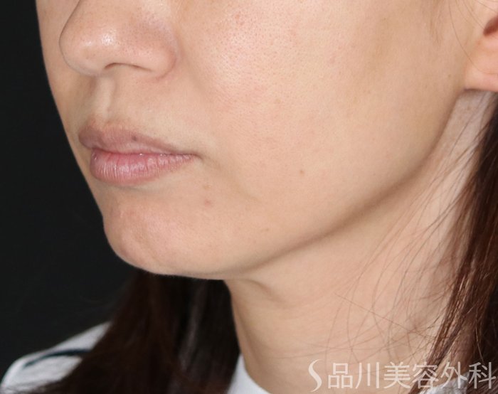 症例NO.72358のBEFORE写真