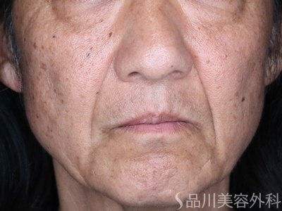 症例NO.75197のBEFORE写真