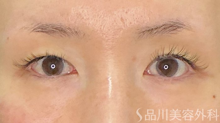 症例NO.73013のBEFORE写真