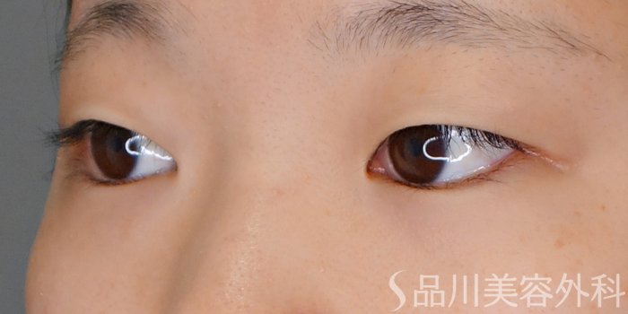 症例NO.70131のBEFORE写真