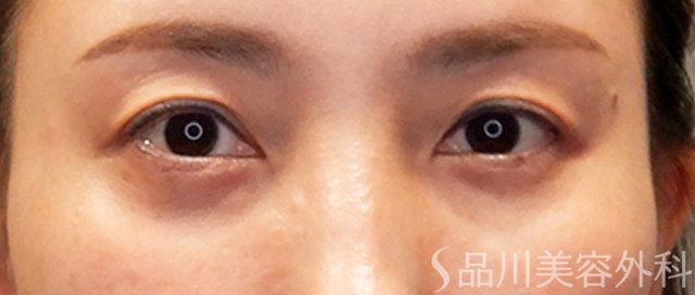 症例NO.71085のAFTER写真
