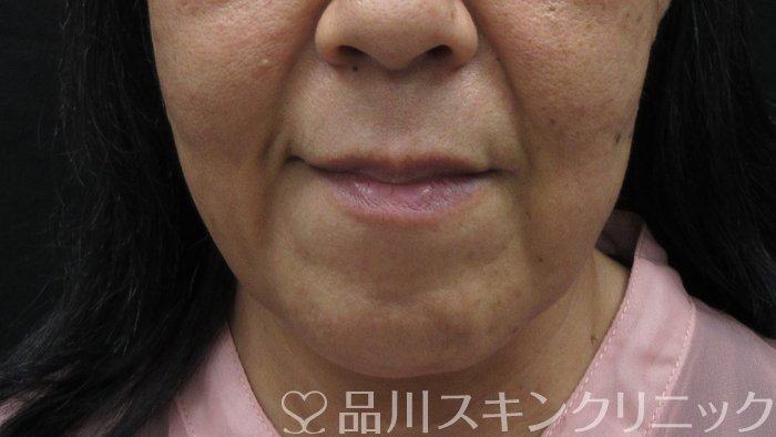 症例NO.74428のBEFORE写真