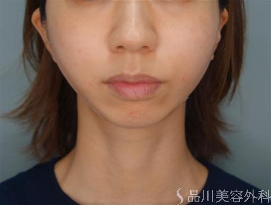 症例NO.54720のAFTER写真