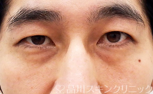 症例NO.62240のBEFORE写真