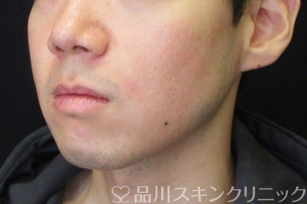 症例NO.66938のAFTER写真