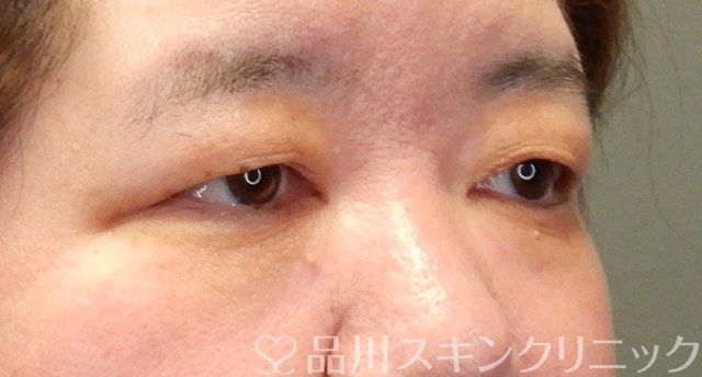 症例NO.64096のBEFORE写真