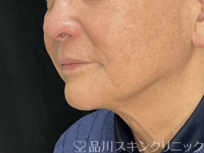 症例NO.73042のAFTER写真