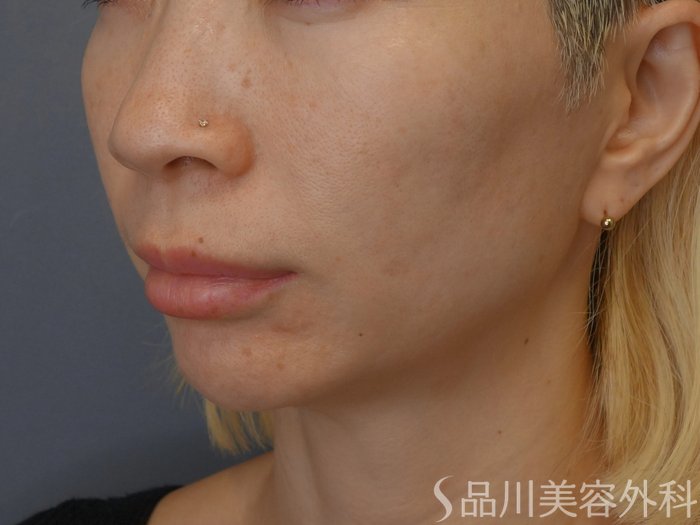 症例NO.75277のBEFORE写真