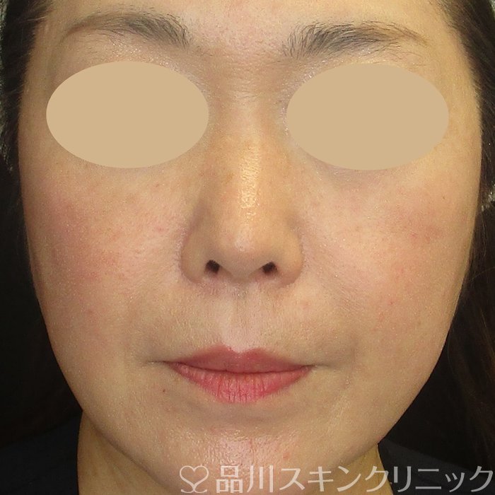 症例NO.73542のBEFORE写真