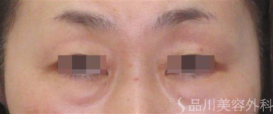 症例NO.60408のBEFORE写真