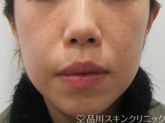 症例NO.26725のBEFORE写真