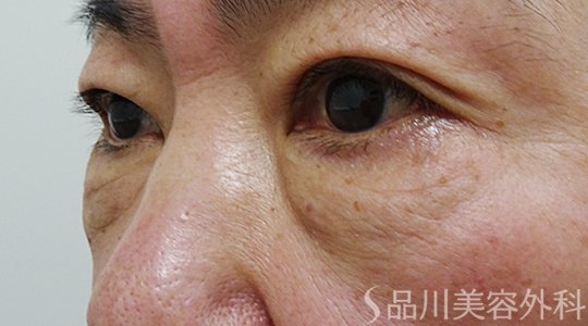 症例NO.74977のBEFORE写真