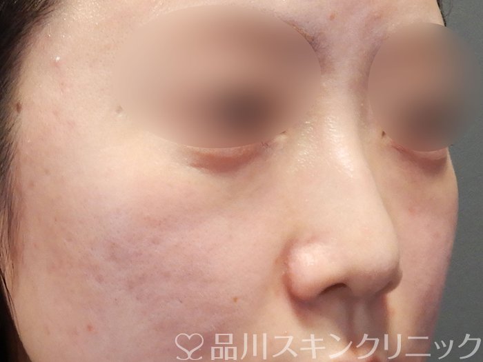 症例NO.72695のBEFORE写真