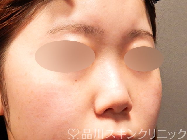 症例NO.69518のBEFORE写真