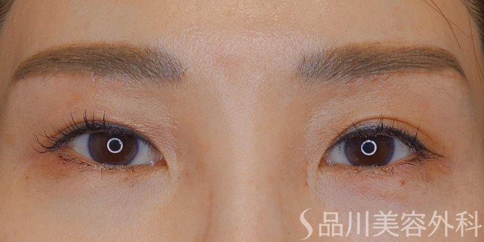 症例NO.72155のAFTER写真