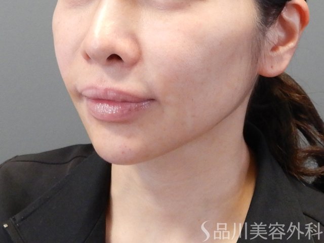 症例NO.68057のBEFORE写真