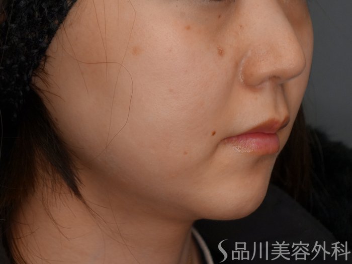 症例NO.75195のBEFORE写真