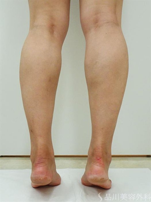 症例NO.44170のAFTER写真