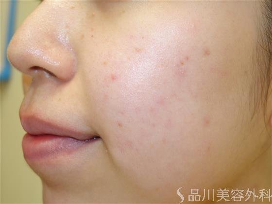 症例NO.40446のAFTER写真