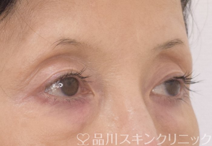 症例NO.69556のBEFORE写真